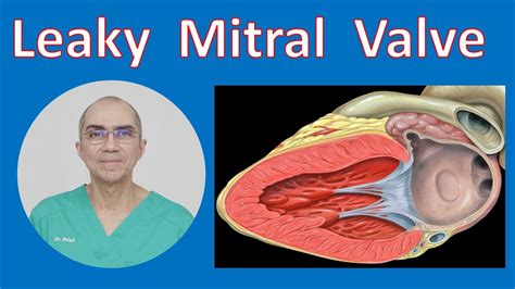 Leaky Mitral Valve - Mitral Valve Regurgitation - YouTube