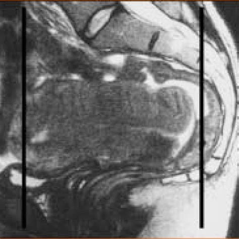 MRI findings corresponding to FIGO staging of endometrial cancer ...