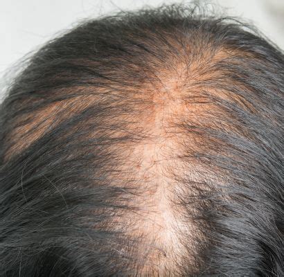 Telogen Effluvium - Hair Loss Causes, Symptoms | Hair Restoration