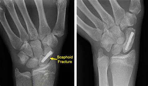 Scaphoid fracture causes, symptoms, diagnosis, treatment & revovery time