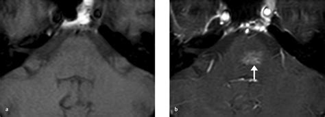 13 Brain Capillary Telangiectasias | Radiology Key