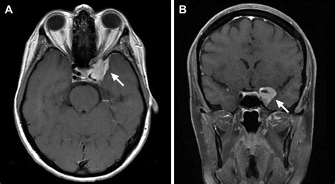 Mri Cavernous Sinus Thrombosis