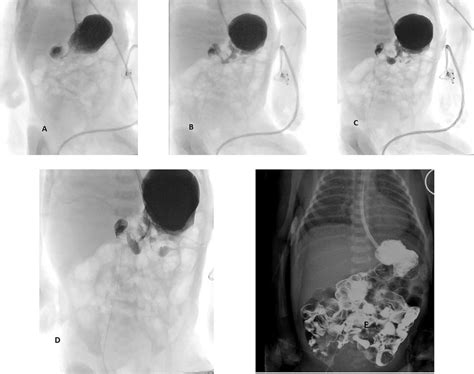 (a-c) Normal upper GI series; (d, e) normal upper GI series and final ...