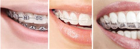 Invisalign in Brooklyn NY - Clear, Invisible Braces for Teens & Adults