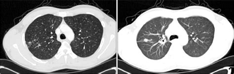 The chest CT reveals multiple newly-developed centrilobular nodules... | Download Scientific Diagram