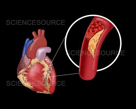 Photograph | Thrombosis in Coronary Artery | Science Source Images