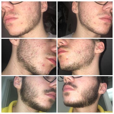 Minoxidil Beard Reddit Before And After Pictures | Beard Style Corner