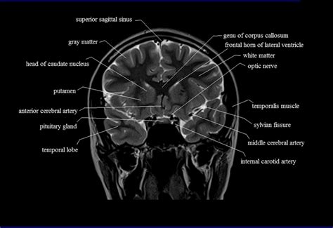 Brain Anatomy | MRI Coronal Brain Anatomy | Free MRI Cross Sectional ...