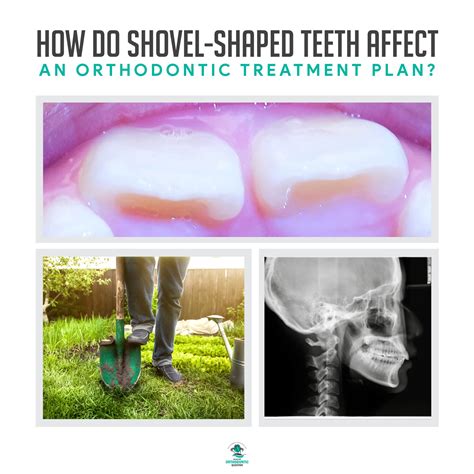 What You Should Know About Treatment Plans for Shovel-Shaped Teeth