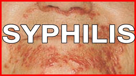 Syphilis Causes Symptoms Rash Treatment Pictures Diagnoses – Otosection