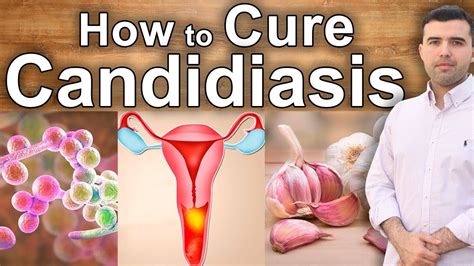 Natural Treatment 100% Effective Against Candidiasis - How to Cure ...