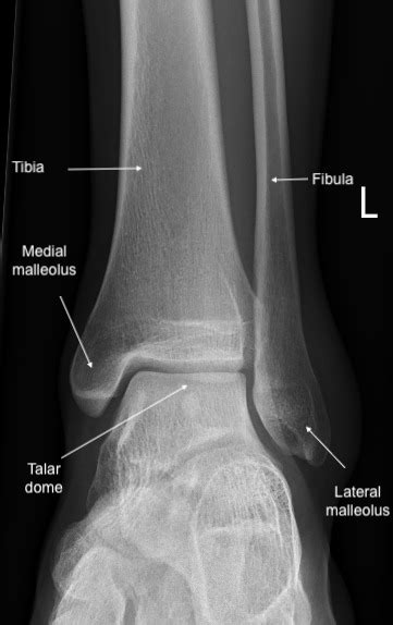 [Figure, Anatomy of the ankle joint demonstated in anteropesterior X-ray of left ankle ...