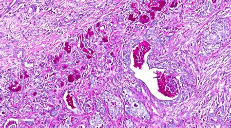 Necrotising sialometaplasia. Hyperplastic and metaplastic ducts ...