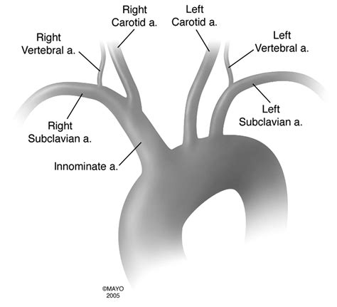 Bovine Aortic Arch Variant in Humans: Clarification of a Common Misnomer | American Journal of ...