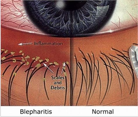 Blepharitis Sarasota | Blepharitis Bradenton | Stye Diagram