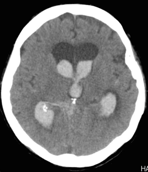 Intra-Ventricular Hemorrhage | New Jersey Brain and Spine