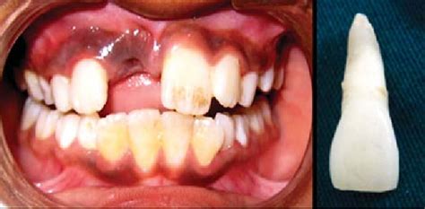 Avulsed tooth, dental trauma guide avulsed tooth