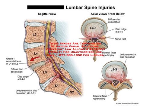 67 Amazing What Is Listhesis Lumbar - insectza