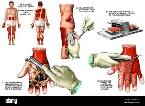 Dermatomes Banque de photographies et d’images à haute résolution - Alamy