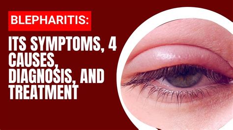 BLEPHARITIS: Symptoms, 4 Causes, Diagnosis, and Treatment