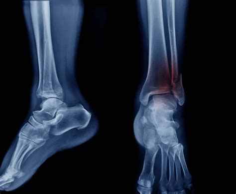 Compound Fracture X Ray