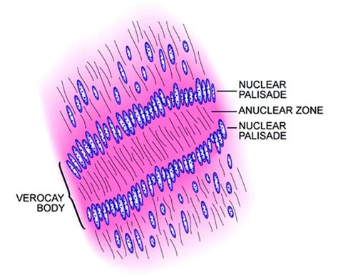 Neurilemmoma - Pathology - Orthobullets