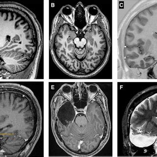 MRI (Coronal, axial and sagittal) pre and postoperative of surgery with ...