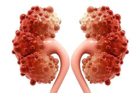 Kidney Cyst - Renal Cyst - Polycystic Kidney Disease - Urologist ...