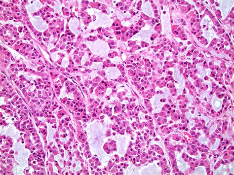 Pathology Outlines - Features to report-adrenal cortical carcinoma