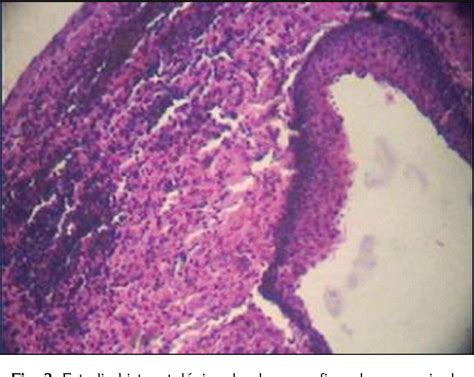 Globulomaxillary Cyst Histology