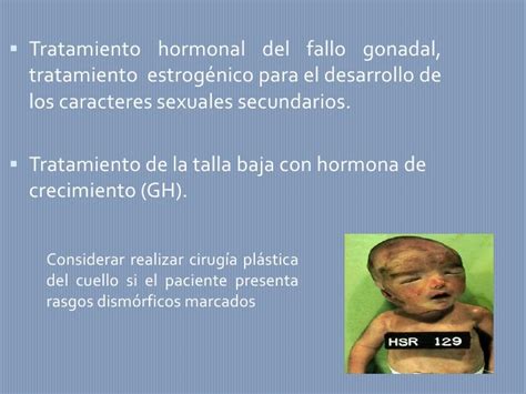 Sindrome de turner, tratamiento