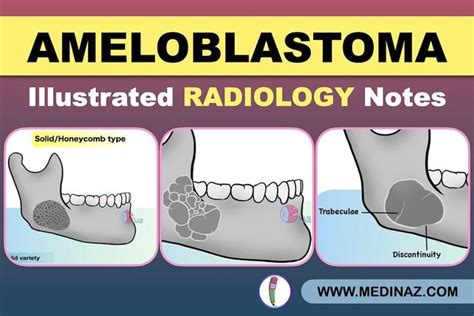 Ameloblastoma Radiology: Dental Radiology Notes | Radiology, Dentistry ...