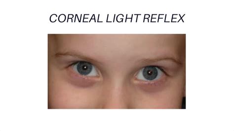 Corneal Light Reflex Abnormal Findings