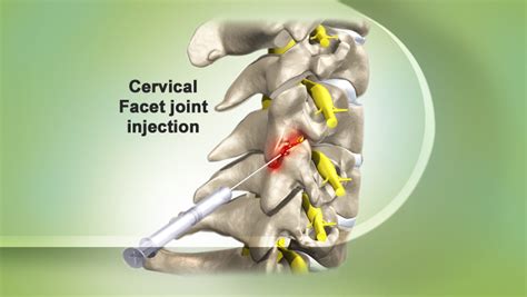 Facet Joint Injection- Indications and Complications | Bone and Spine