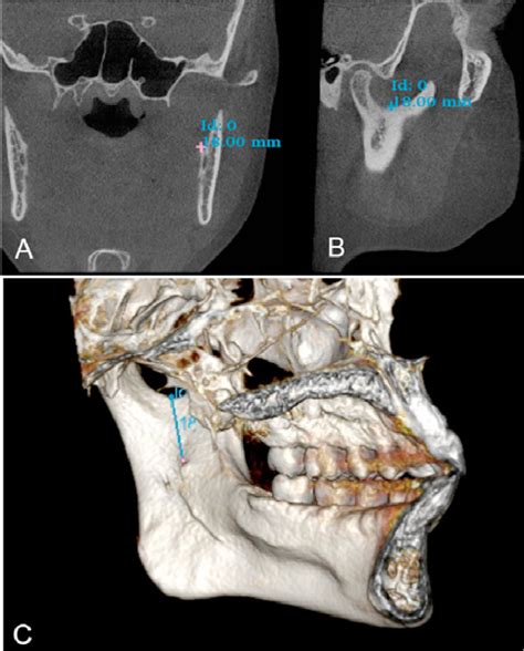 Figure 1 from Mandibular foramen location | Semantic Scholar