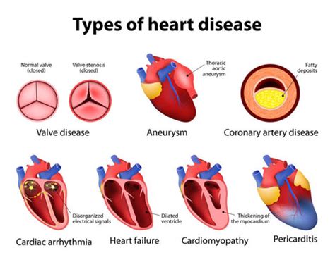 National Heart Valve Disease Awareness Day — Mountainside Medical Equipment