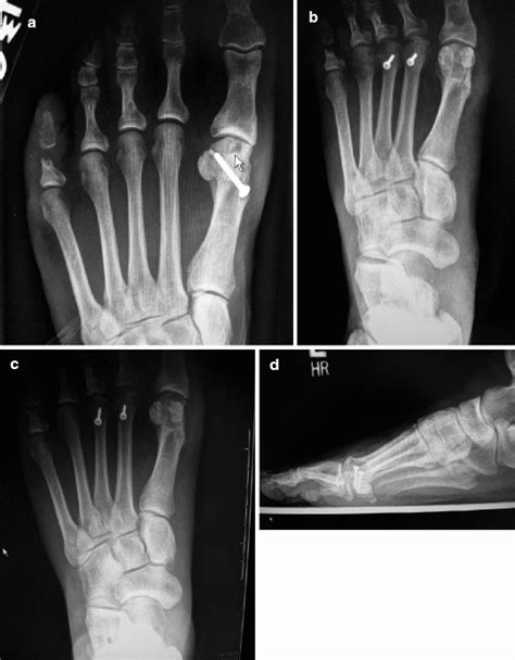 Turf Toe Injuries | Musculoskeletal Key