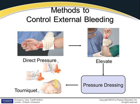 External Bleeding Treatment