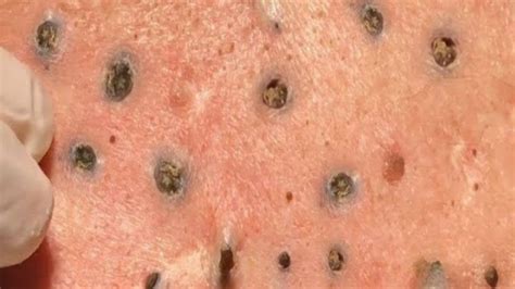 HUGE BLACKHEADS SUCCESSFULLY REMOVED SUFFER FOR HOW MANY YEARS - YouTube