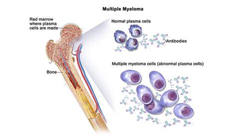 Multiple Myeloma – Causes & Risk Factors | New Life Ticket - Part 2