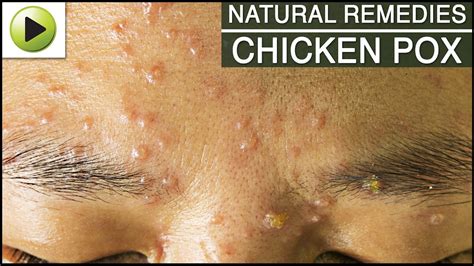 Skin Care - Chicken Pox - Natural Ayurvedic Home Remedies - YouTube