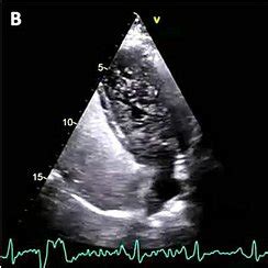 Contrast-enhanced echocardiogram. Apical four‐chamber views after ...