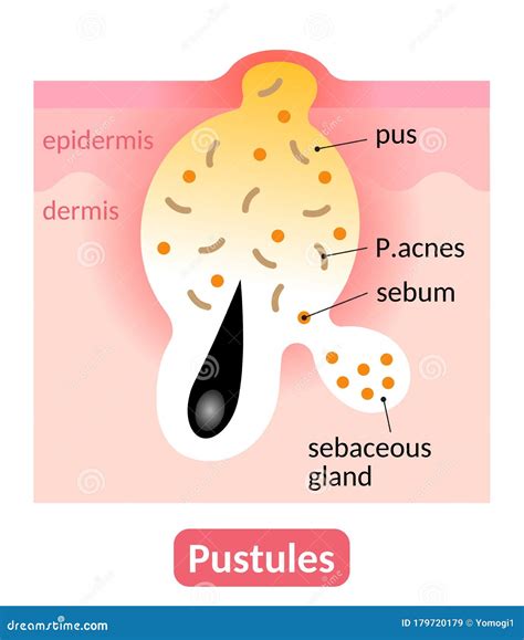 Acne. Pustule. Cross-section Of A Human Skin. Hair Follicle With Pus Cartoon Vector ...