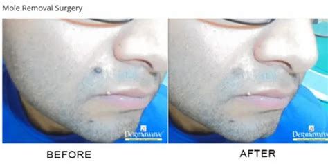 Mole Removal Surgery Service, Laser Treatment, Rs 1000/mole Dermawave Private Limited | ID ...