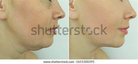 151 Before After Chin Weight Loss Images, Stock Photos & Vectors ...