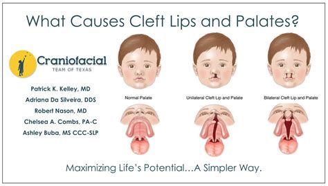 What Causes Cleft Lips and Palates? - Dell Children's Craniofacial Team of Texas