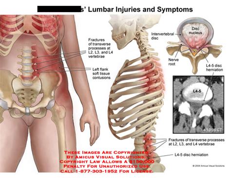 L4 Fracture