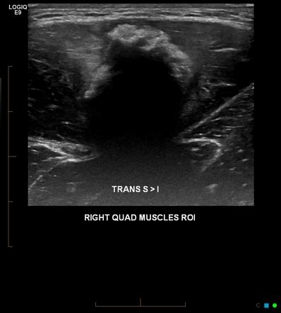 Myositis Ossificans Ultrasound