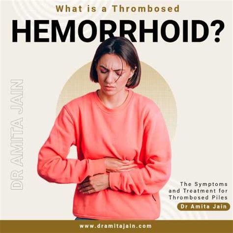 What is a Thrombosed Hemorrhoid? Symptoms and Treatment