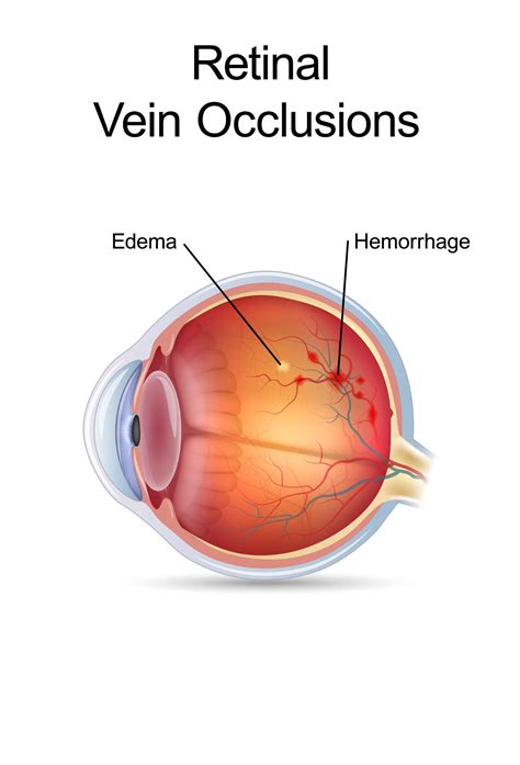 Retinal Vein Occlusion - IRAN Health Tourism Organizer - Iran Medical ...